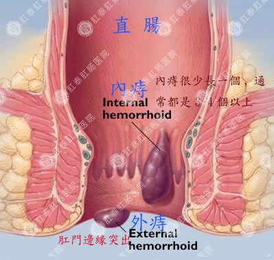 痔疮