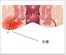 怎样治疗肛瘘不错