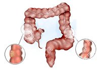 结肠恶变百科