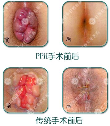 传统手术与医博手术前后对比