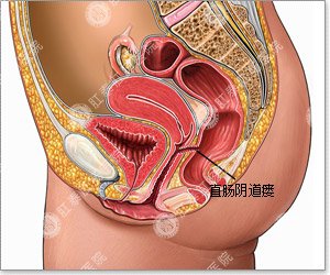 直肠阴道瘘