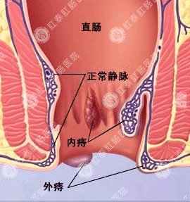 肛门里面有异物感怎么办？