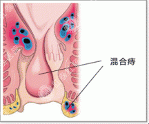 混合痔便血的原因有哪些？