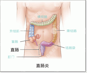 福州医博肛肠医院有限公司





春天急性肠炎怎么回事？