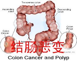 多吃水果可以预防结肠恶变吗